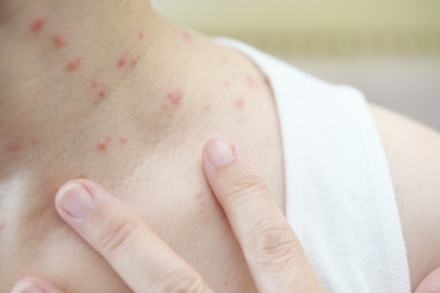 あせもの治し方は？症状や原因、適切なケア方法を解説 イシャチョク