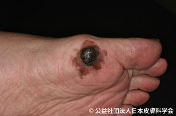 砂かぶれ様皮膚炎子どものホームケアの基礎