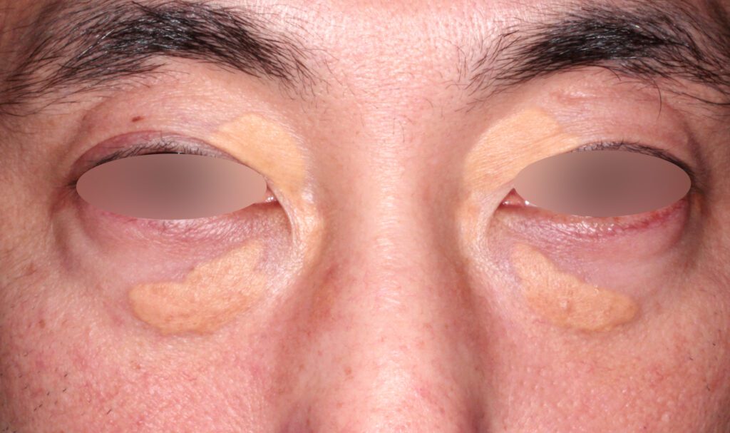 札幌医科大学 形成外科まぶたの異常まぶたの腫瘍 できもの