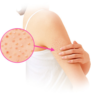 腕・二の腕にできるニキビの原因とは？治し方や自宅でできるセルフケアを解説ハダメディア by BIHADADO.TOKYO