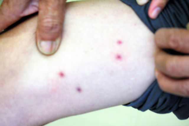 ダニ類による感染症 Q3 - 皮膚科Q＆A 公益社団法人日本皮膚科学会