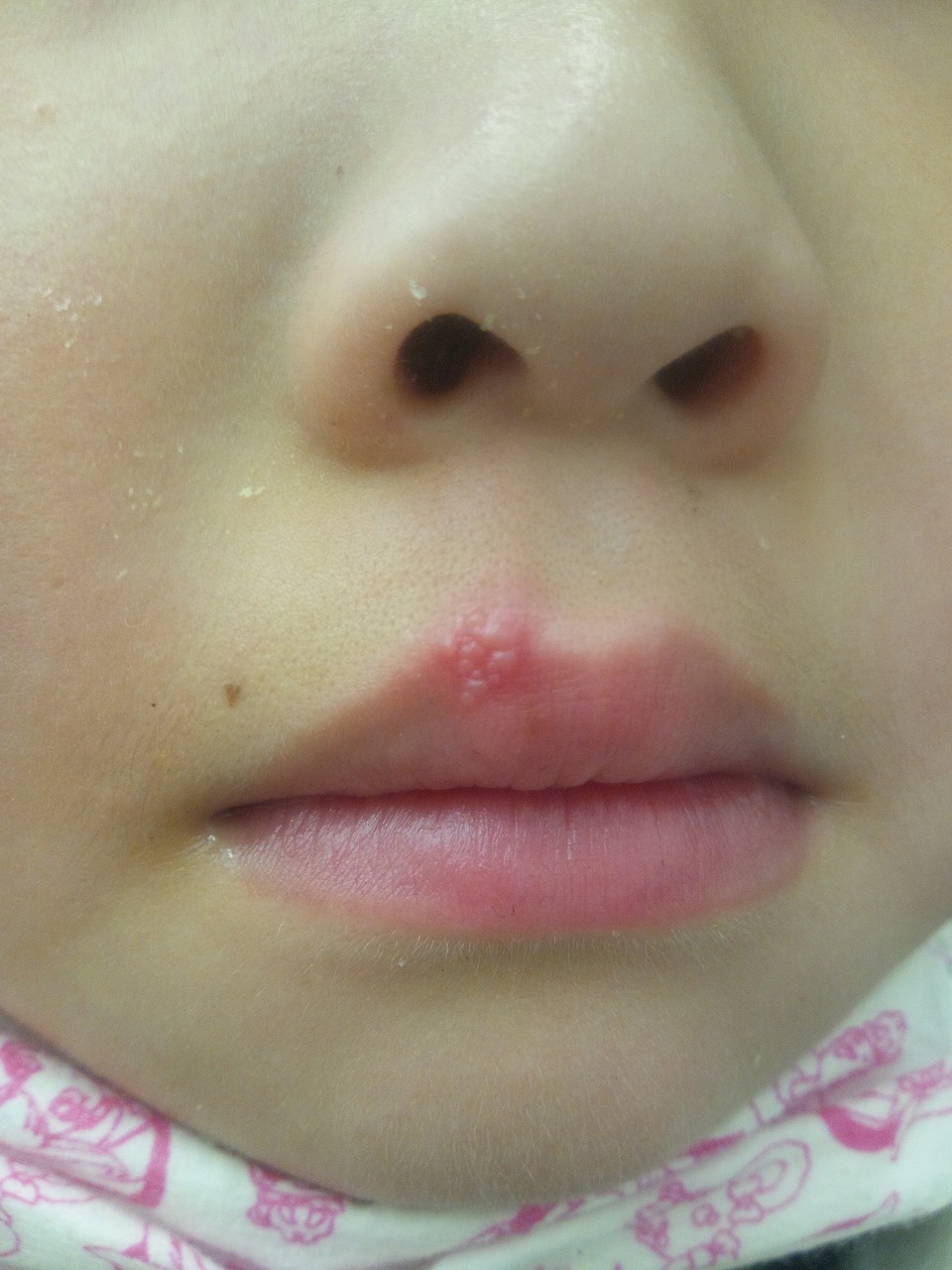 唇が痛い野田市 小児科 千葉県 こどもの花粉症 こどもの漢方 喘息 アトピー性皮膚炎 アレルギー 結節性痒疹 たんぽぽこどもクリニック