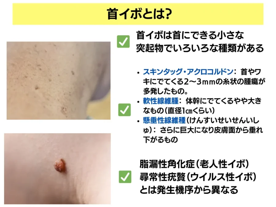 妊娠中、首のイボ大量発生д II