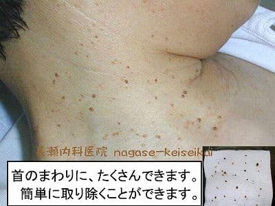首イボはなぜできる？原因と治療法を医師が解説 - 首イボDr