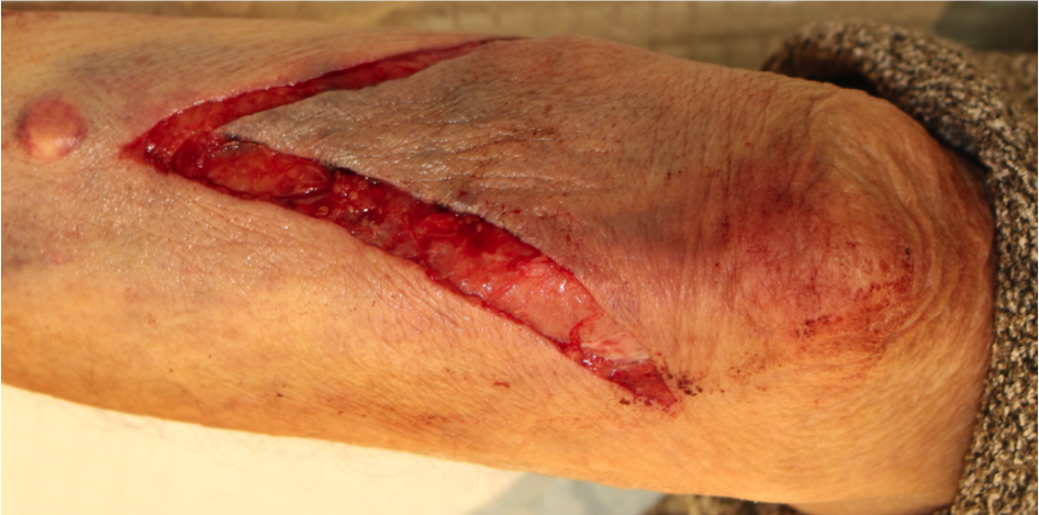 形成外科的縫合プリモ麻布十番クリニック 美容整形ブログ