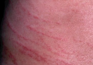 身に覚えのないミミズ腫れの原因は？かゆい症状を写真で解説ヨクミテ - 医師監修の医療メディア