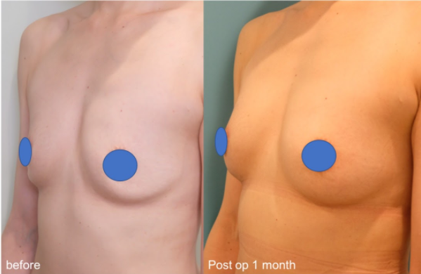 卒乳後の胸のしわしわ対策とおすすめナイトブラをご紹介