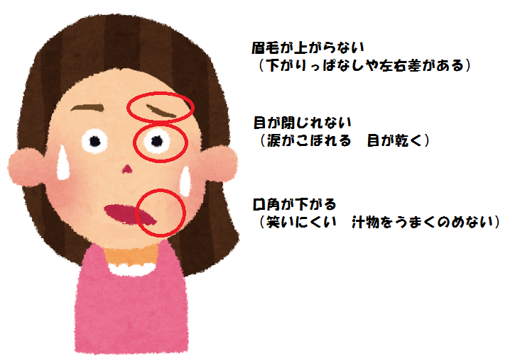 顔面神経麻痺後の再建術・外科的治療～見た目を改善させる治療～奈良 樹のひかり形成外科・皮ふ科