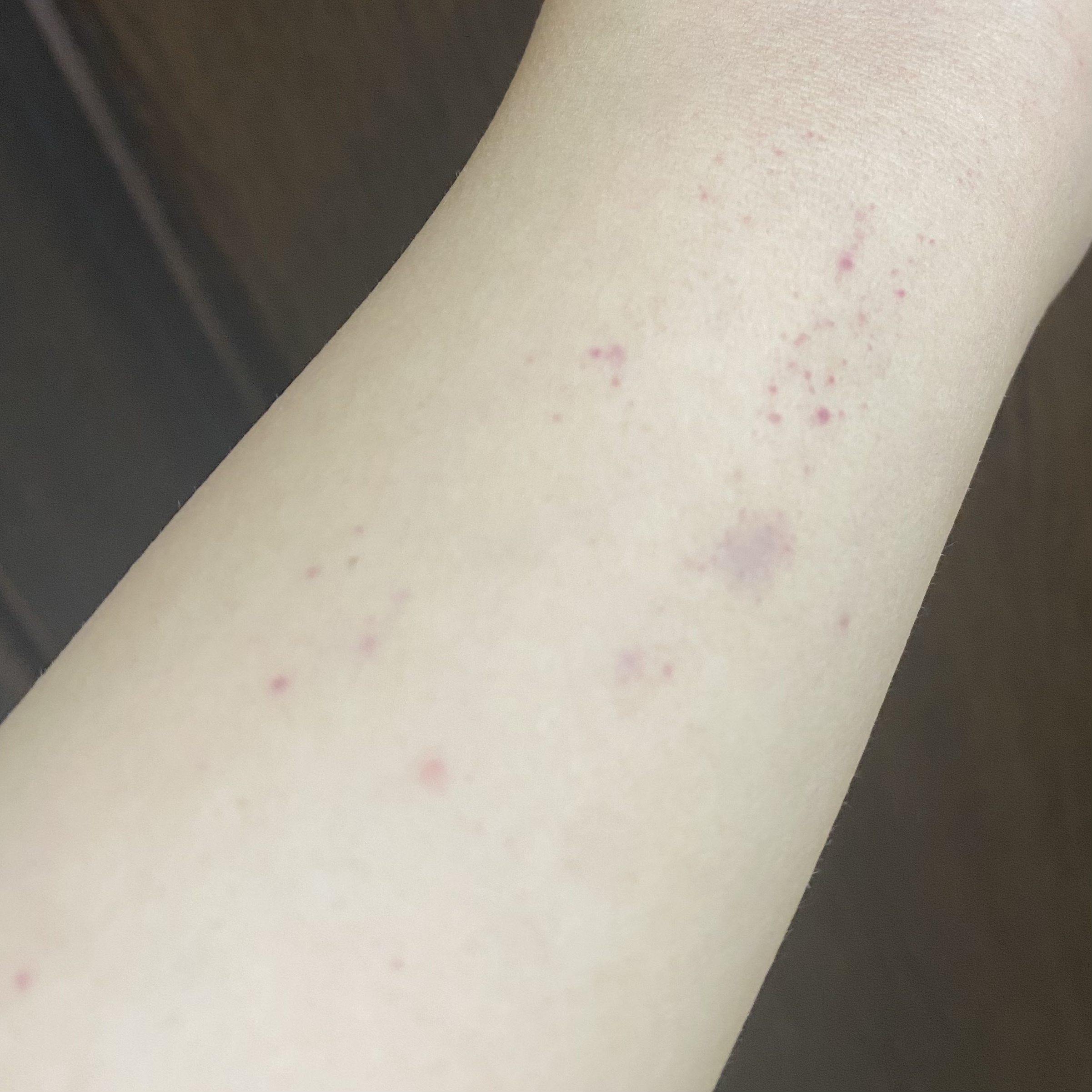 重いものを持った時の内出血？18歳女です。ここ一年ほど、重い鞄や袋を持ったり背- Yahoo!知恵袋