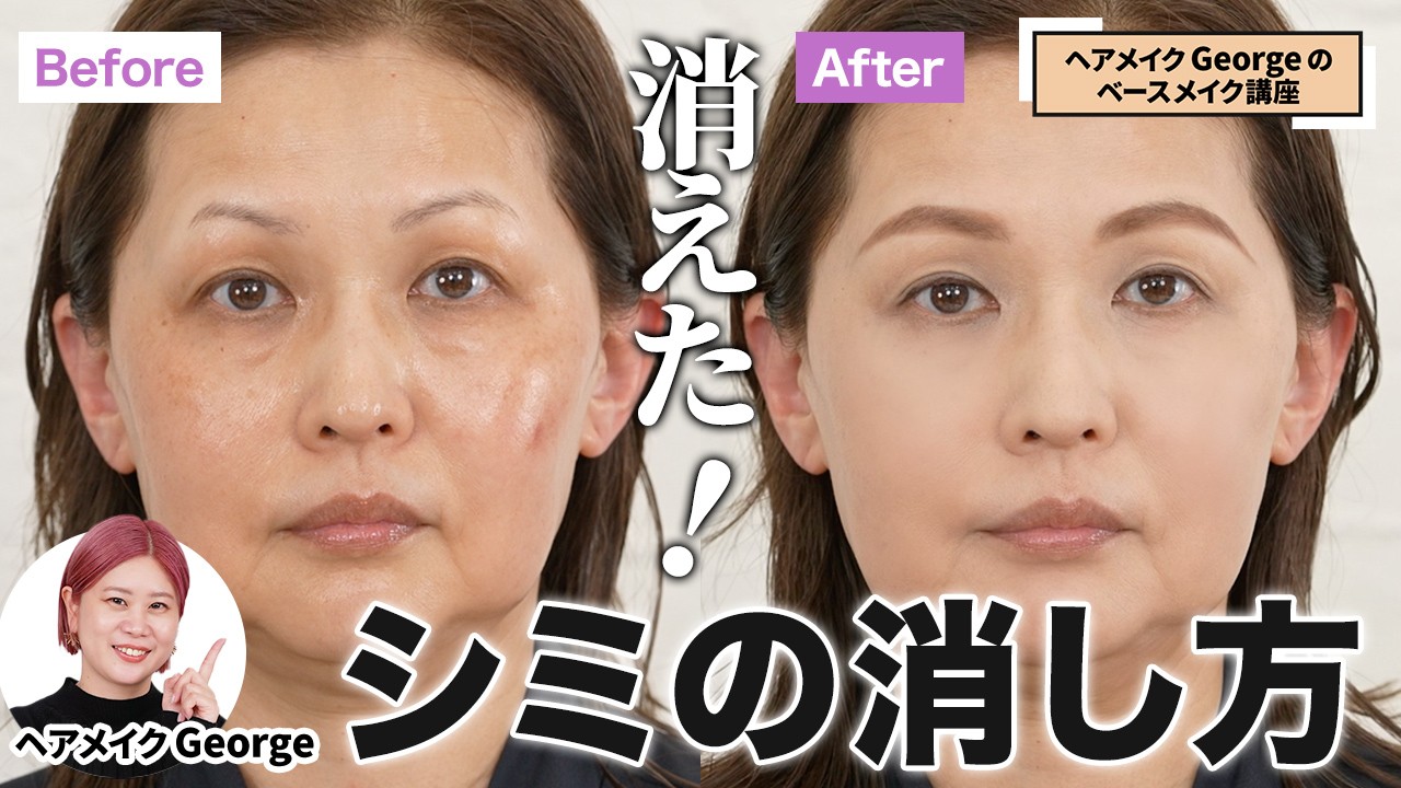 顔のシミを消す5つの方法！皮膚科でのシミ取りと自分で取る方法 - 東京・大阪の美容皮膚科ならFLALU フラルクリニック