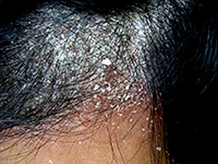 気温と湿度が高い夏は、頭皮からの汗や皮脂の分泌量が増えます。カビ 真菌 の一種で皮膚の常在菌であるマラセチア菌は、皮脂を栄養源にしており、皮脂の量が増えるとマラセチア菌も増殖します。通常では問題がない菌なのですが、過剰に増殖するとマラセチア菌が皮脂を