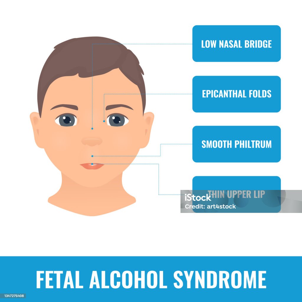 胎児性アルコール症候群たいじせいアルコールしょうこうぐんtaijiseiarukoorushoukougun 은