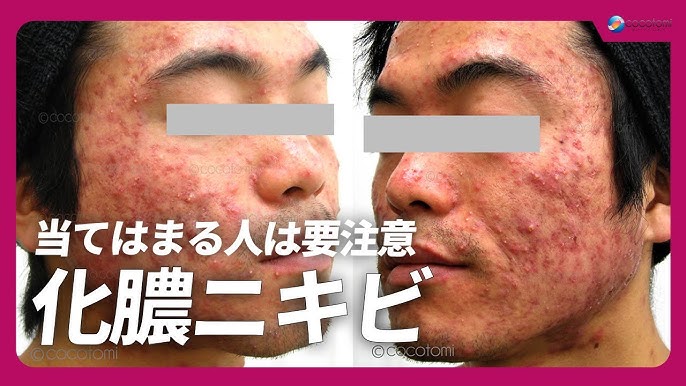 洗顔後の肌に、白いものが！？サッポー美肌塾