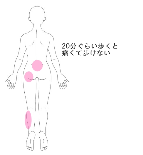 お尻が痛いタイプの腰痛 原因と治療についてうらさき鍼灸院 京都府 向日市