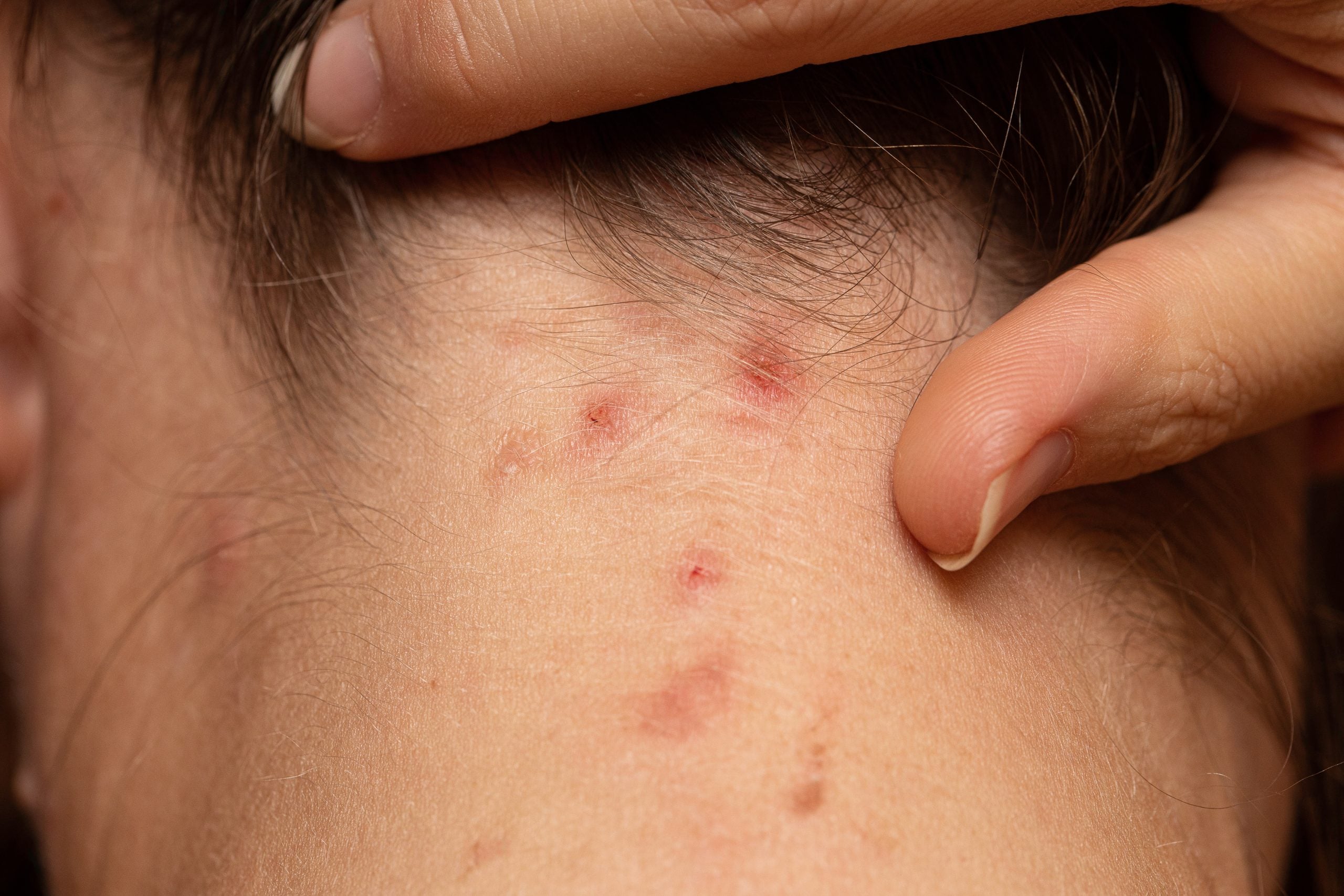 後頭部首の付け根押すと痛い