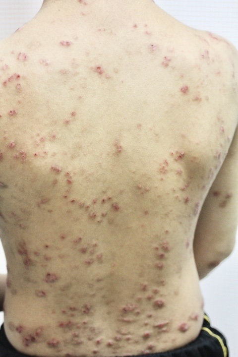 5. アトピー性皮膚炎の診断