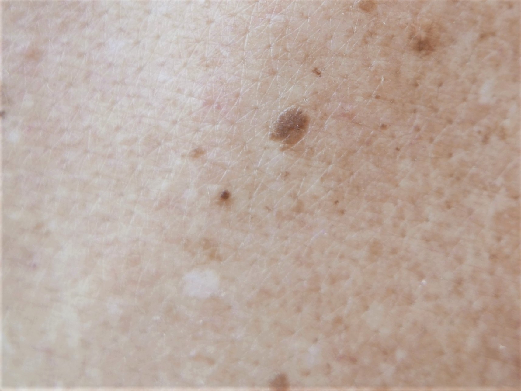 尋常性白斑は治った人がいる？自然治癒から最新治療まで徹底解説治験モニターのススメ