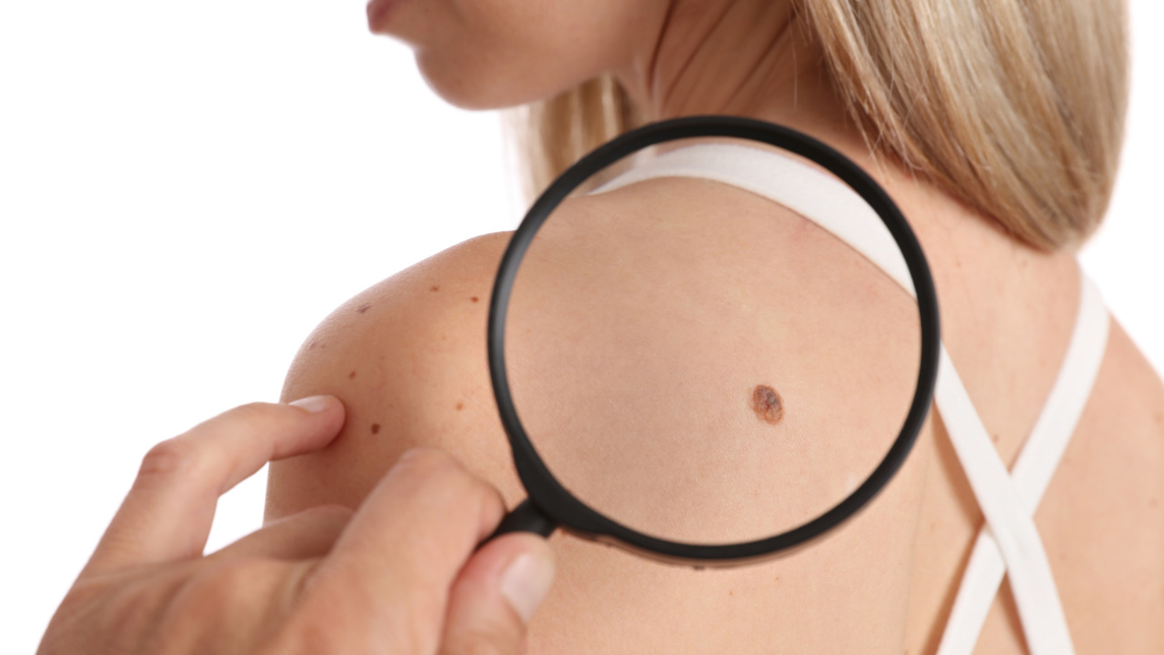 ひまし油でイボ取れたよ！ カソーダを実際に1ヶ月試した効果と注意点あみんブログ