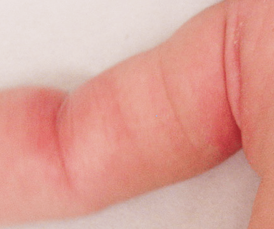 猛暑で増加する大人のあせも薬局・薬店で相談できる皮膚トラブルヒフシルワカル