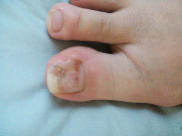 教えてフクミ先生！ 足爪に血豆ができちゃった！爪のいろいろな情報が集まるサイト爪のお悩み解決ー爪ドットコム