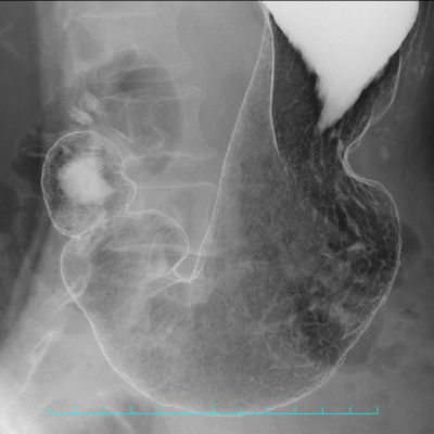 バリウムと胃カメラ - さくら内視鏡クリニック品川
