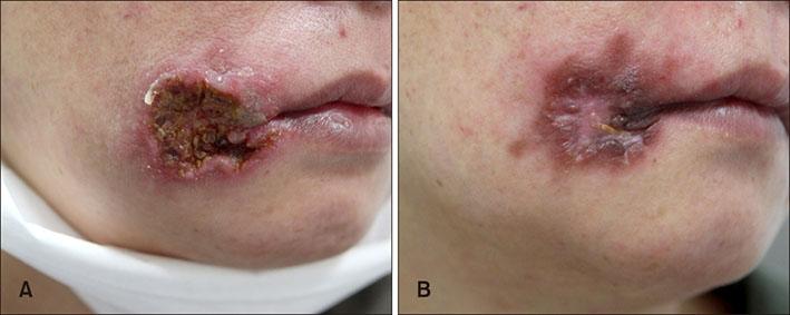 梅毒 Syphilisグローバルヘルスケアクリニック－麴町駅徒歩1分の内科・小児科・感染症内科・渡航外来