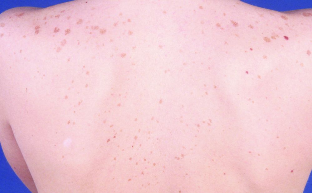 アジソン病の看護基本情報や症状、看護の5つのポイントナースのヒント