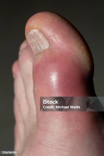 トウモロコシ、カルス、カロシティ、ひび割れ、肌の軟化、美容処置のために足の裏にクリームを塗るPremium写真