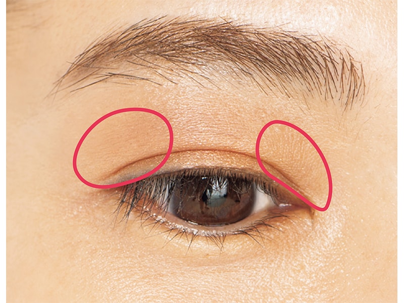 まぶたが腫れぼったく見える原因は？改善に有効な施術は？ 公式 オザキクリニック 新宿・目黒祐天寺・羽村