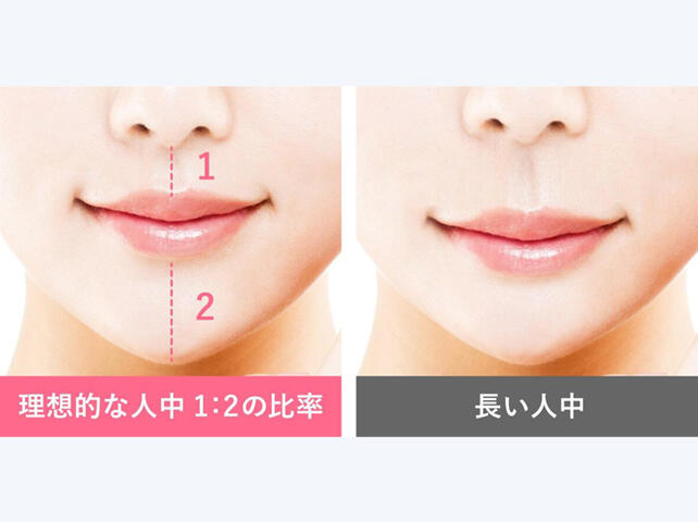 人中短縮手術のデメリットは？医師が徹底解説金沢の美容外科はeクリニック