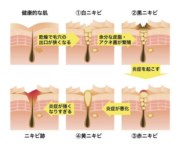 ニキビの原因とは皮膚科なら東京・明治通りクリニック 渋谷