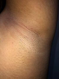 ワキガは脱毛で対策できる？脱毛と臭いの関係を紹介！メンズ脱毛百科事典 リンクスペディア