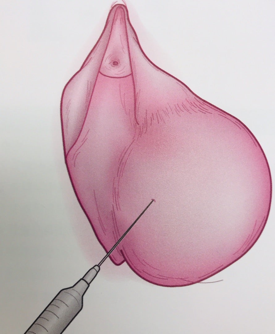 外陰部の痒み、痛み、不快感症状から考える婦人科疾患