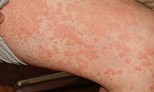 夏風邪の「ヘルパンギーナ」と「手足口病」が流行しています。たくゆう耳鼻咽喉科クリニック 院長ブログ