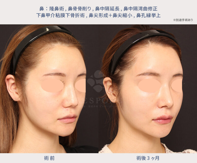 サキ吉さんの斜鼻治療 斜鼻修正、鼻中隔延長、鼻尖形成、梨状口縁細片軟骨移植 猫貴族手術 、口角挙上、全て肋軟骨 術後1ヶ月 解説動画MAeClinic マエクリ