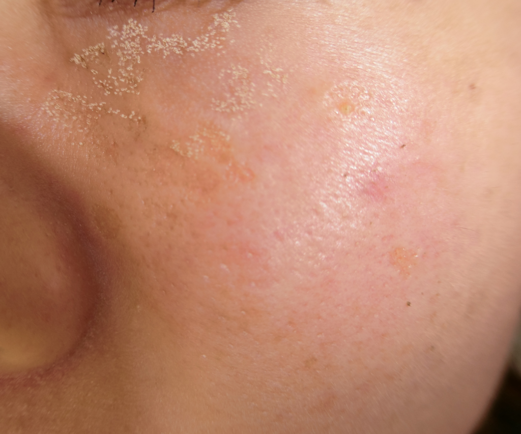 繰り返す大人のほうれい線ニキビの対策方法を徹底解説