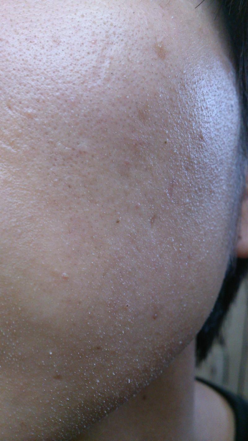 角質培養 1年目の肌今日のひとこと、ふたこと - 楽天ブログ