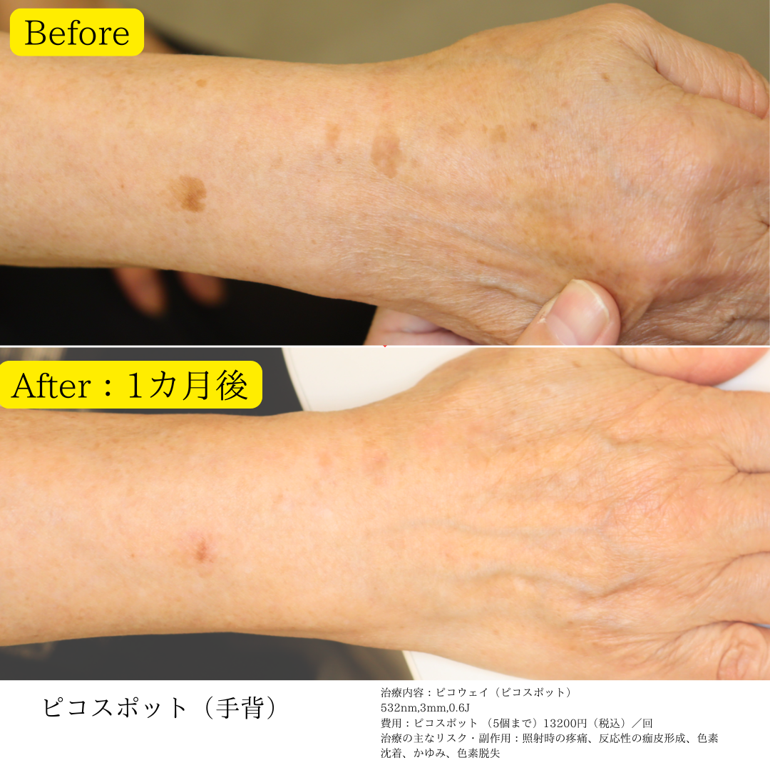 色素脱失 しきそだっしつ shikisodasshitsu 是什么意思？-日文字典，日文中文 简体 字典Mazii