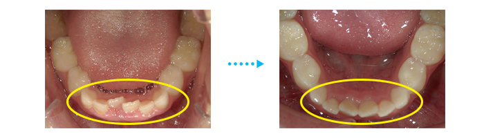 悪い乳歯の歯並びとは？子どもの歯並びが悪くなる原因と予防法を解説千歳烏山やの歯科