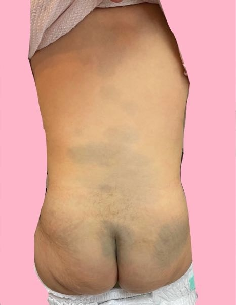 異所性蒙古斑とは？治療方法や効果、費用、リスク、注意点についてままのて