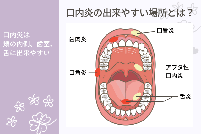 口内炎について知ろう大正製薬
