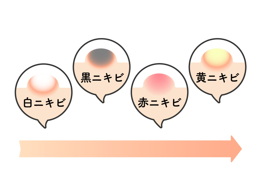 鼻ニキビのスピリチュアルな意味とは？鼻の下・鼻の頭・鼻の中など解説！ホギホギ