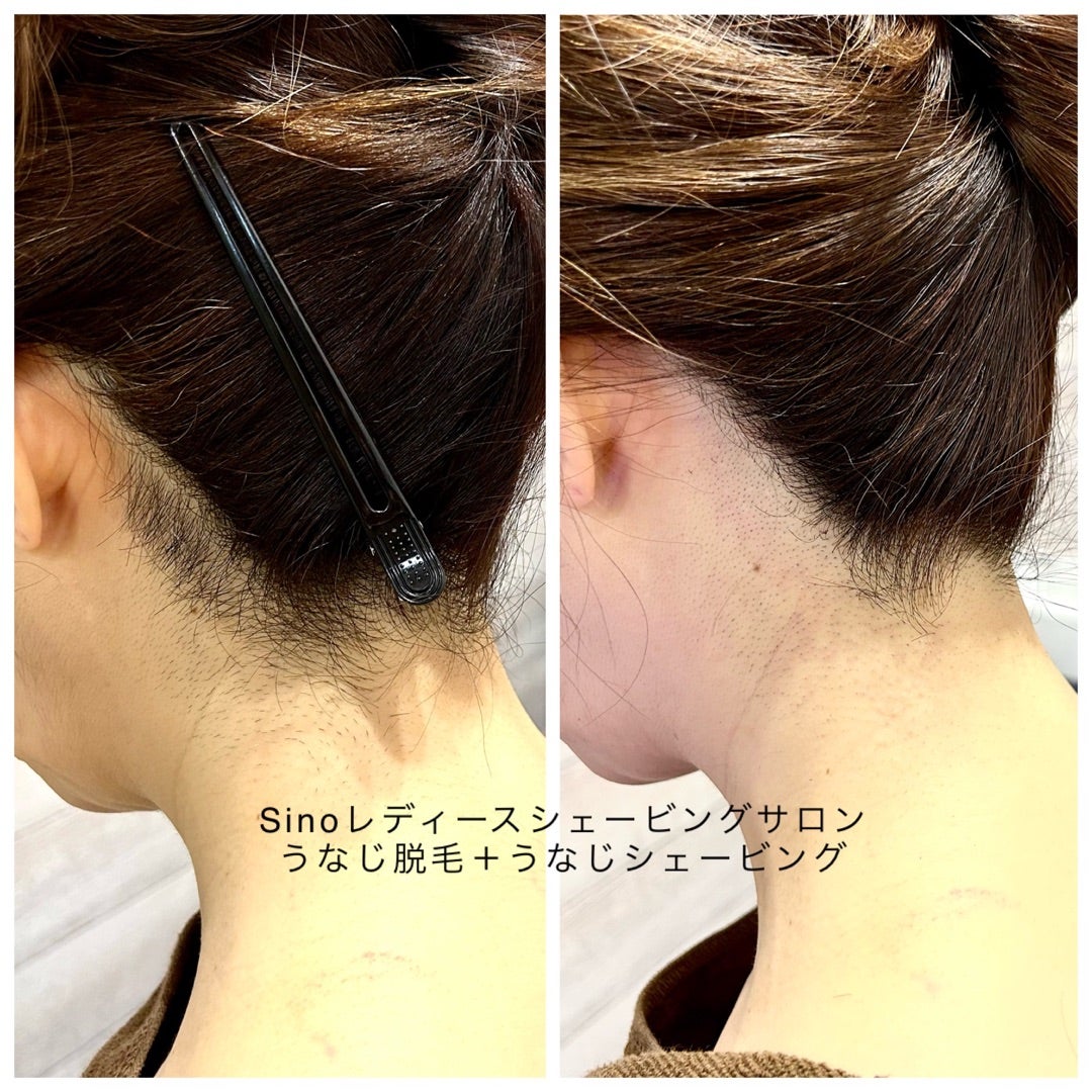 うなじの生え際を整える髪の毛部分の医療脱毛の痛み・回数・料金を解説 - 医療脱毛専門美容皮膚科レナトゥスクリニック