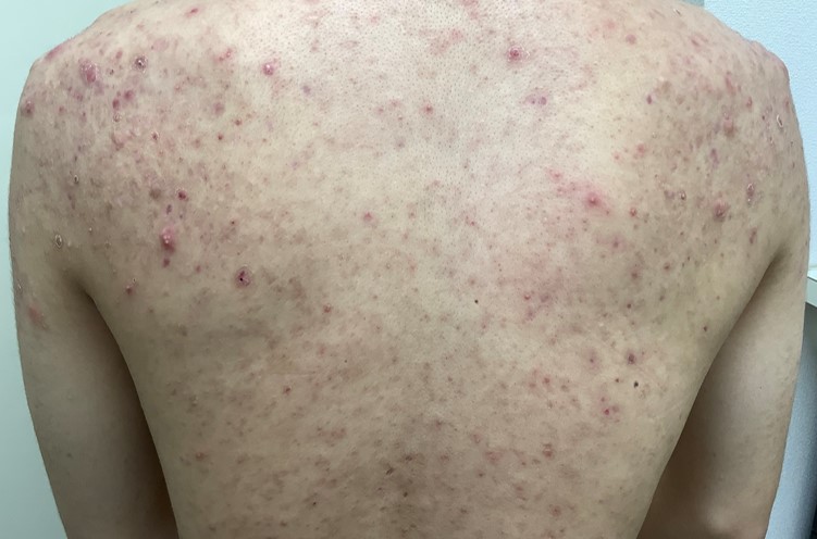 明石でアトピー性皮膚炎・湿疹・蕁麻疹でお悩みの方へ明石市寿鍼灸院