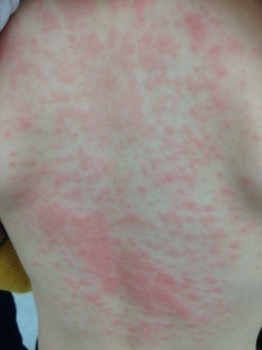 お子様の皮膚疾患についてきむら内科小児科クリニック名古屋市緑区