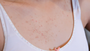胸吹き出物・ニキビの治し方
