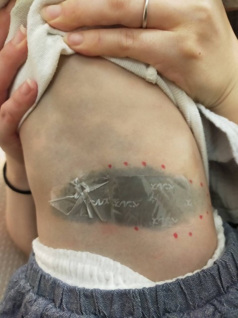 岡山で異所性蒙古斑なら当院へ MONGOLIAN SPOTS