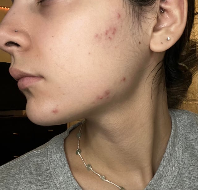 ニキビマップ付き ニキビの場所ごとの原因と治し方を徹底解説！ハダメディア by BIHADADO.TOKYO