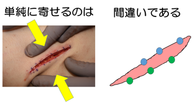 適切な縫合とは？ – 医療法人 双英会 YUKI皮フ科形成外科一宮市時之島の皮膚科、形成外科