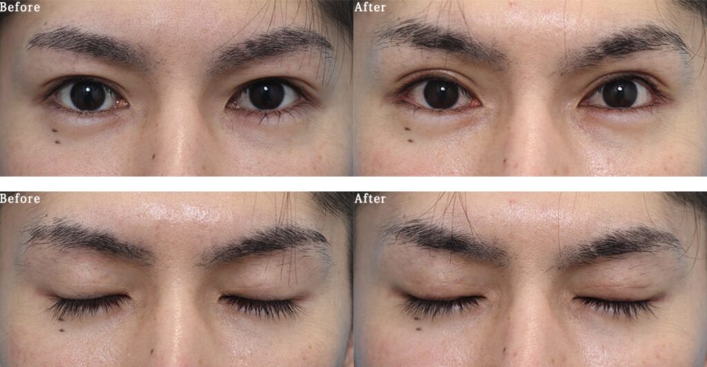 助けてください！これは腫れてるだけですか？？私は普段から、アイプチを- Yahoo!知恵袋